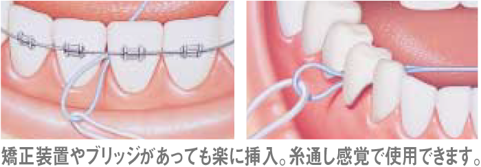 矯正装置やブリッジがあっても楽に挿入。糸通し感覚で使用できます。