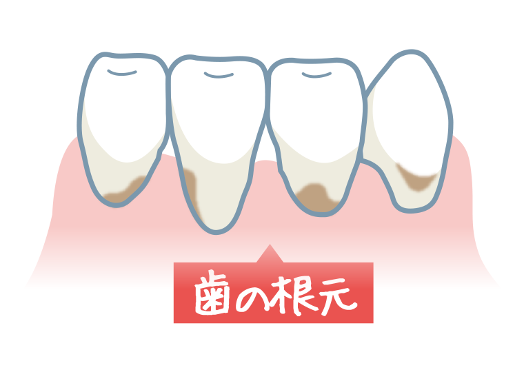 歯の根元