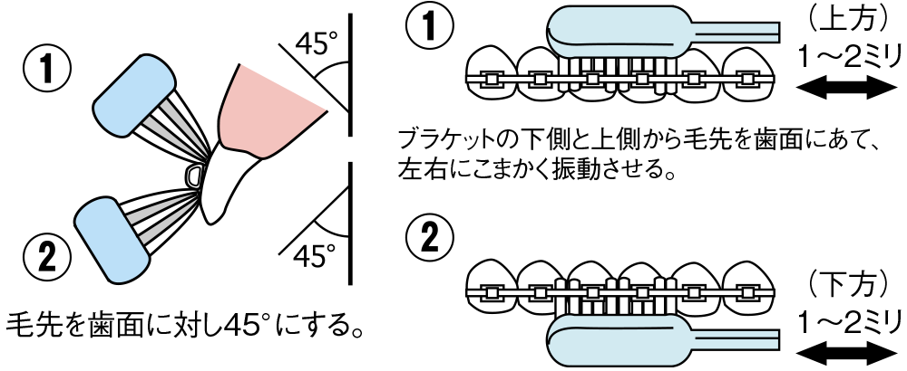 ブラケットを中心に上下に分けてみがく