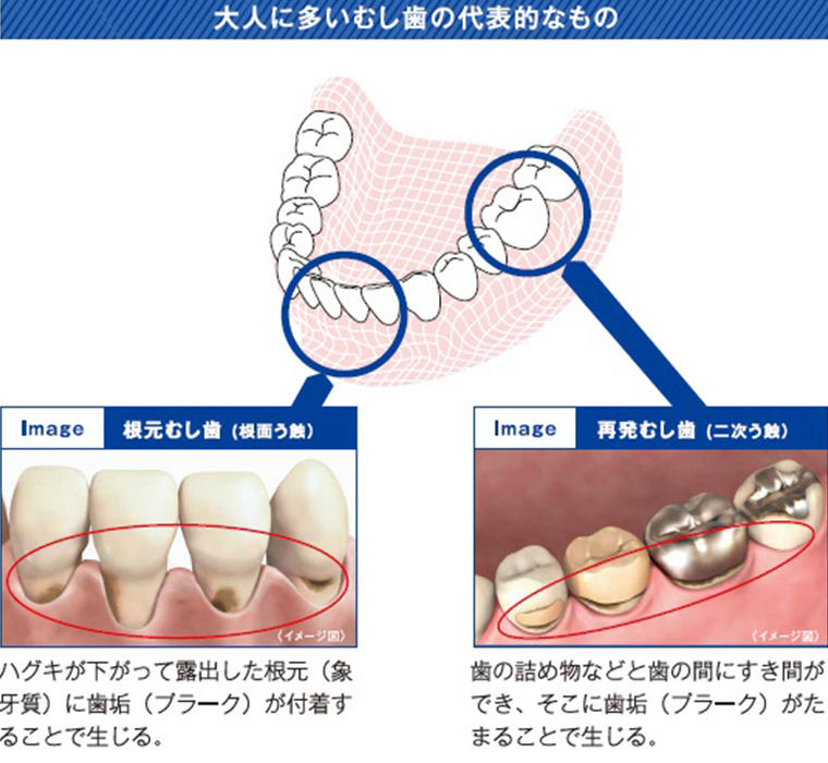 Image 根元むし歯(根面う蝕) ハグキが下がって露出した根元(象牙質)に歯垢(プラーク)が付着することで生じる。 Image 再発むし歯(二次う蝕) 歯の詰め物などと歯の間にすき間ができ、そこに歯垢(プラーク)がたまることで生じる。