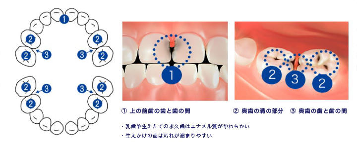 1上の前歯の歯と歯の間 2奥歯の溝の部分 3奥歯の歯と歯の間 ・乳歯や生えたての永久歯はエナメル質がやわらかい ・生えかけの歯は汚れが溜まりやすい