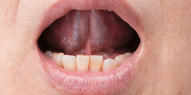 5.口蓋（上あご）も舌で広く塗り広げます。全体に塗り広げた後、余分なジェルは拭き取るか吐き出してください。