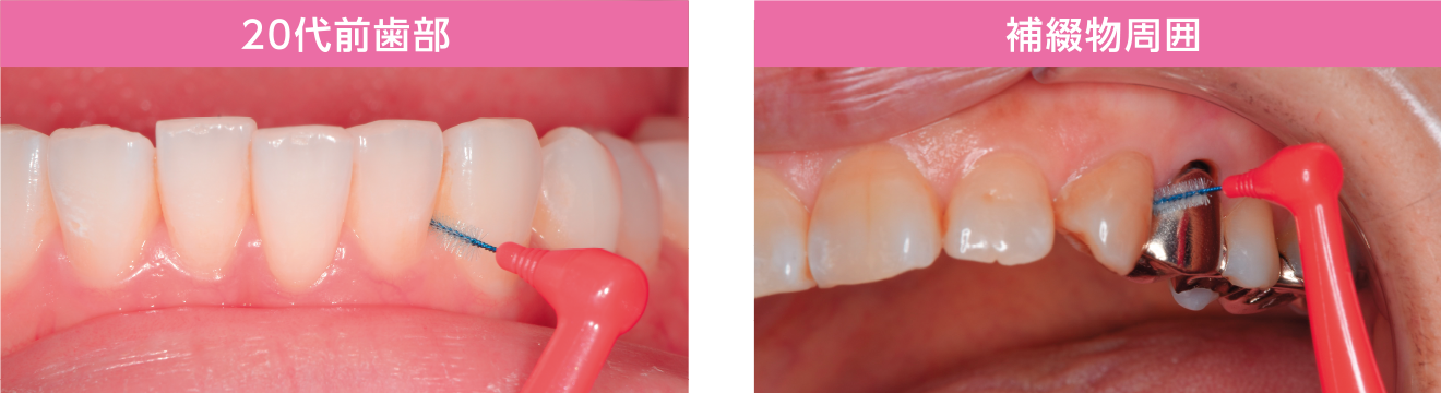 ガムシリーズ最細の歯間ブラシが狭い歯間部にも挿入できます。