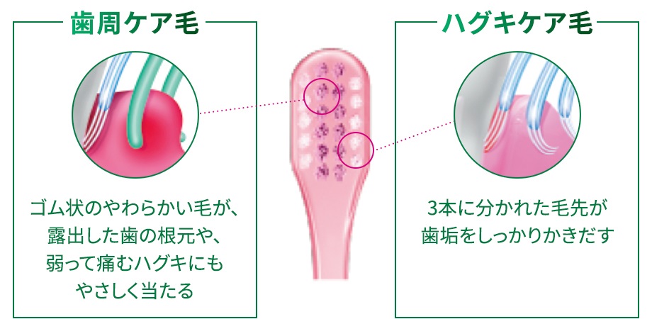 知覚過敏や歯周病の方でもやさしくみがける2種類の毛先