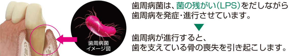 歯周病菌は、菌の残がい(LPS)をだしながら歯周病を発症・進行させています。 歯周病が進行すると、歯を支えている骨の喪失を引き起こします。 歯周病菌イメージ図