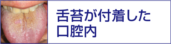 舌苔が付着した口腔内