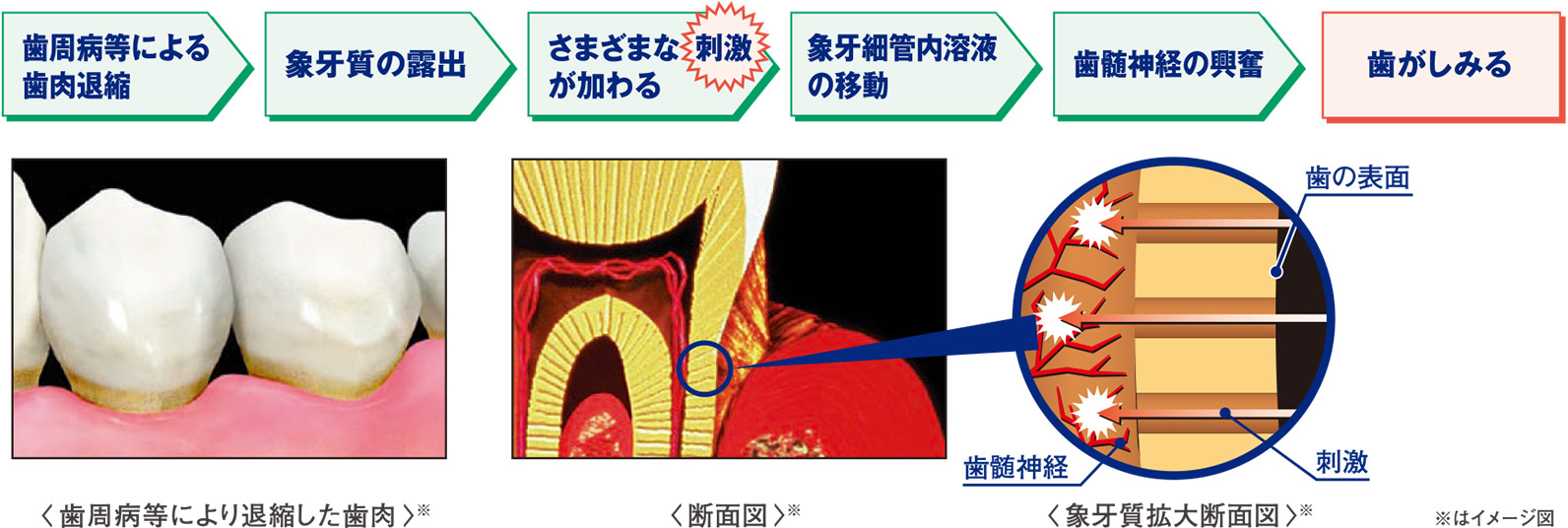 歯周病等による歯肉退縮 象牙質の露出 さまざまな刺激が加わる 象牙細管内溶液の移動 歯髄神経の興奮 歯がしみる