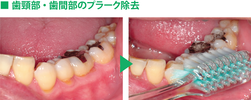 ■歯頸部・歯間部のプラーク除去